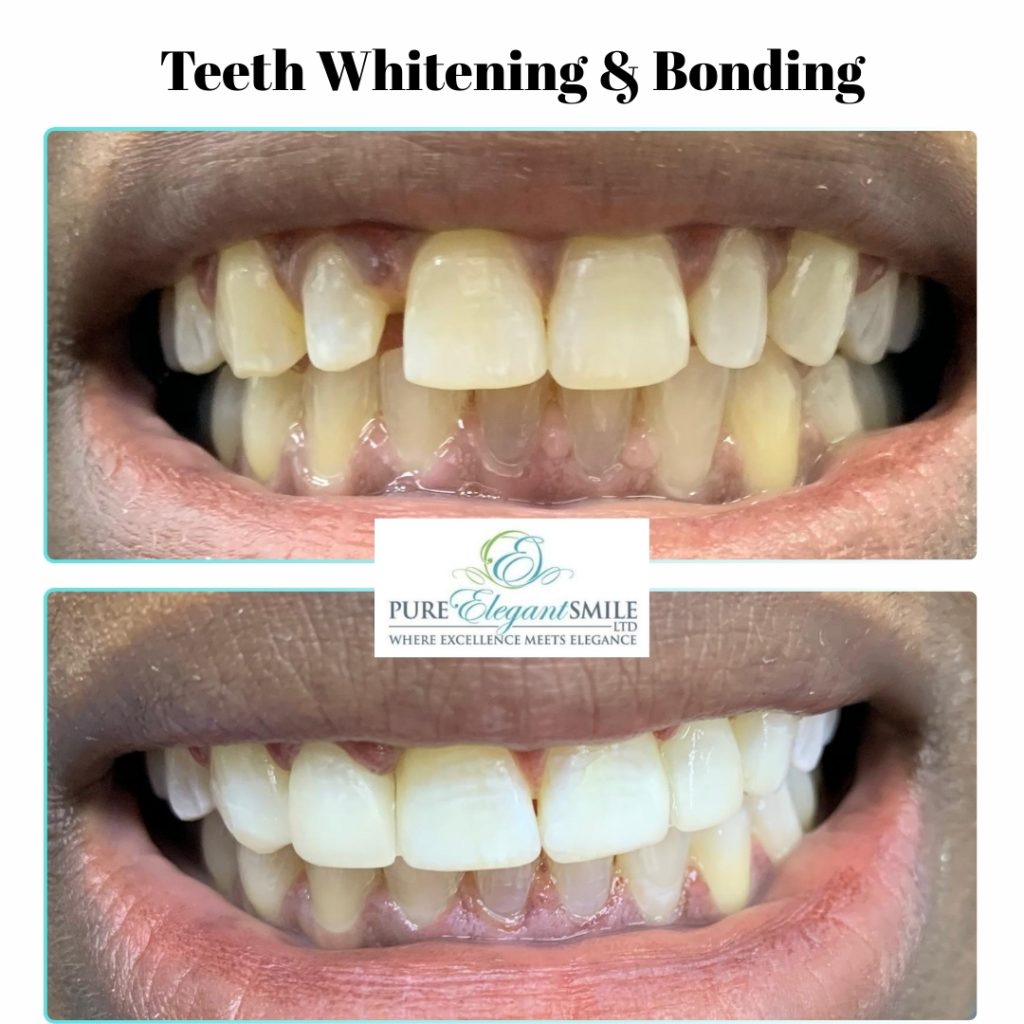 Teeth Whitening & Bonding Kennington